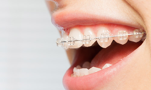 example of clear braces