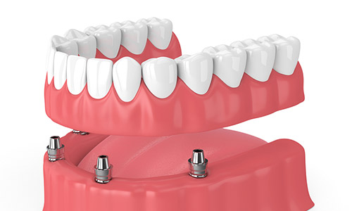 digital example of implant supported overdentures
