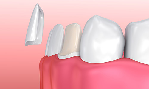 illustration of a veneer placement