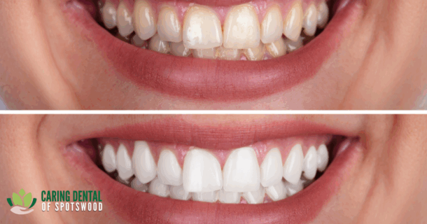 They’re Called Pearly Whites For A Reason